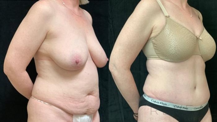 Before & After Tummy Tuck Case 541 View #3 View in San Jose, CA