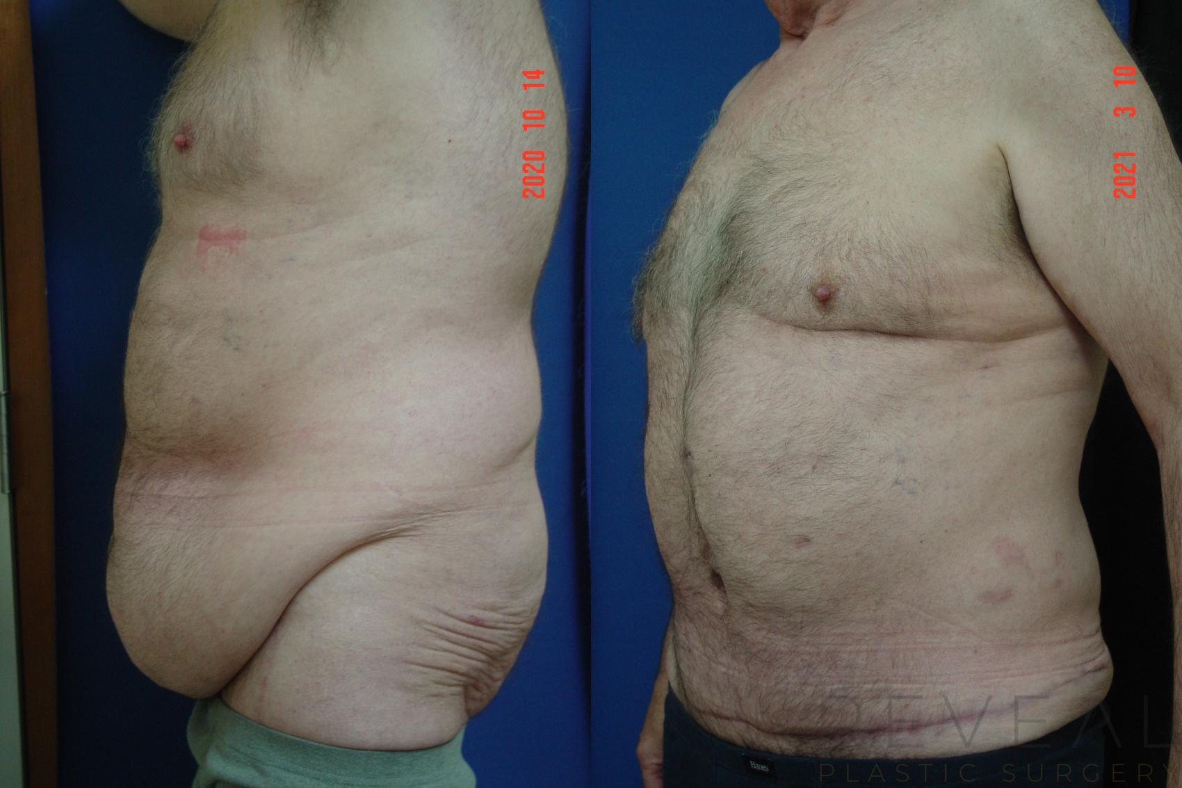 Before & After Liposuction Case 544 View #1 View in San Jose, CA