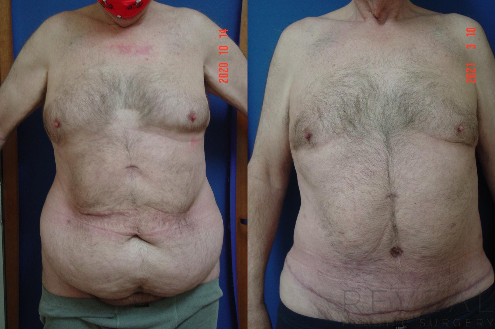 Before & After Male Breast Reduction Case 544 View #2 View in San Jose, CA