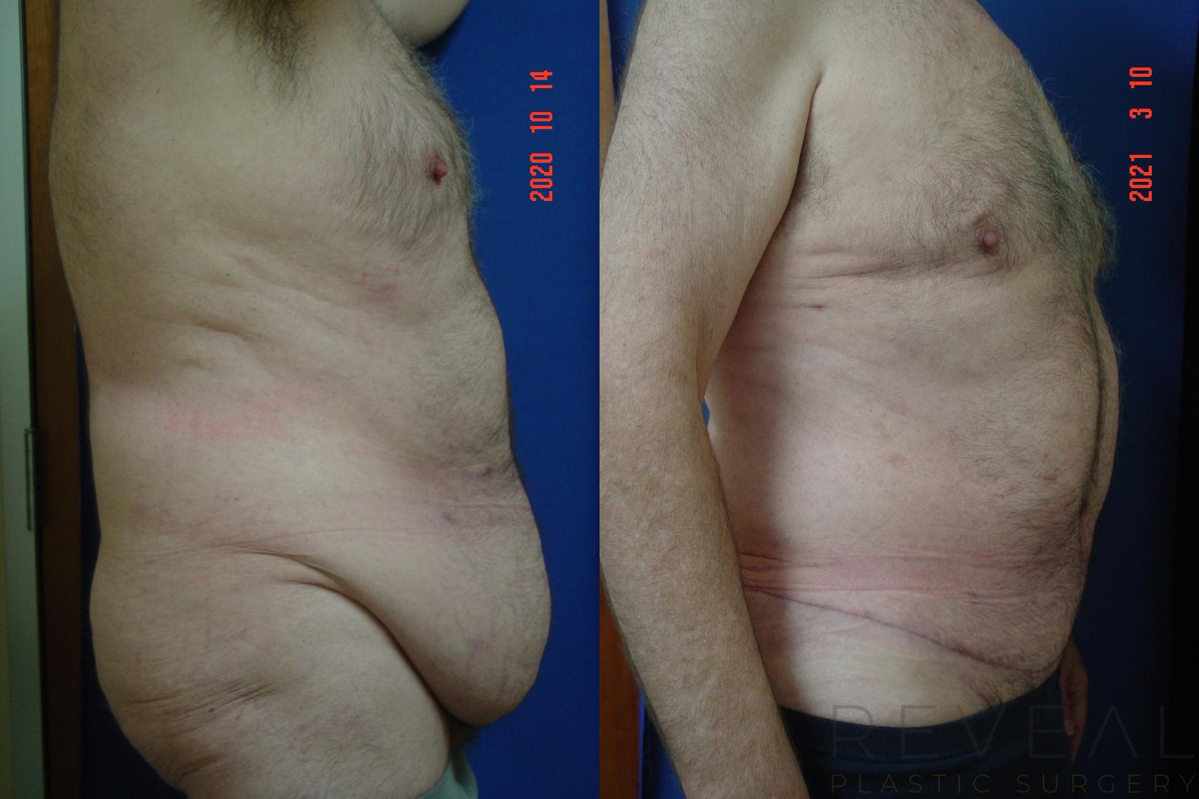 Before & After Male Breast Reduction Case 544 View #3 View in San Jose, CA