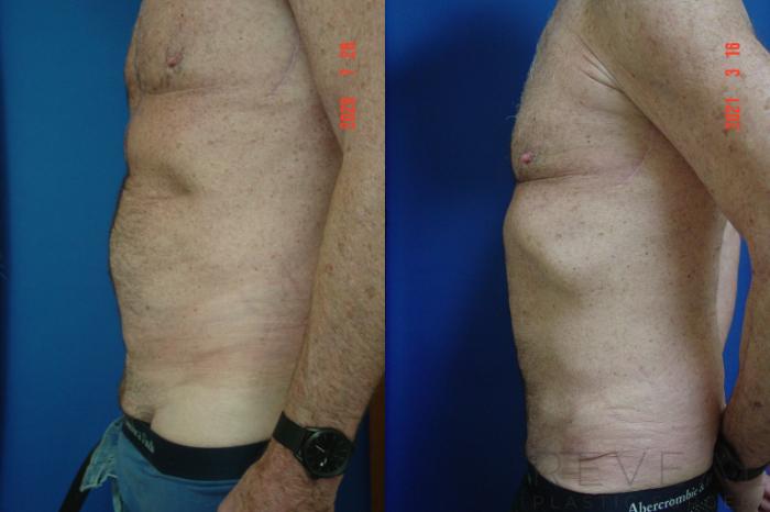 Before & After Tummy Tuck Case 547 View #1 View in San Jose, CA