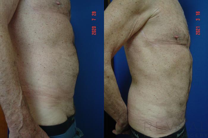 Before & After Tummy Tuck Case 547 View #2 View in San Jose, CA