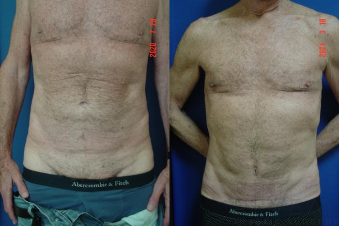 Before & After Tummy Tuck Case 547 View #3 View in San Jose, CA