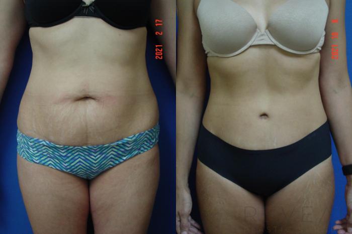Before & After Tummy Tuck Case 585 View #1 View in San Jose, CA