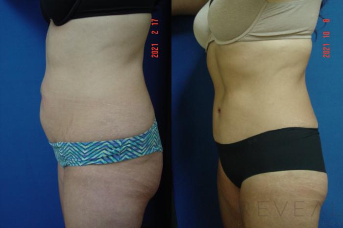 Before & After Tummy Tuck Case 585 View #2 View in San Jose, CA