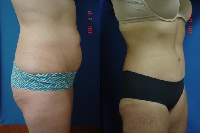 Before & After Tummy Tuck Case 585 View #3 View in San Jose, CA