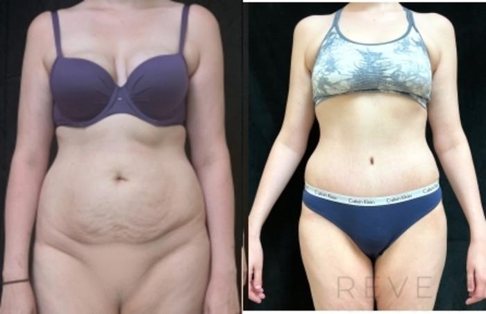 Before & After Tummy Tuck Case 605 Front View in San Jose, CA