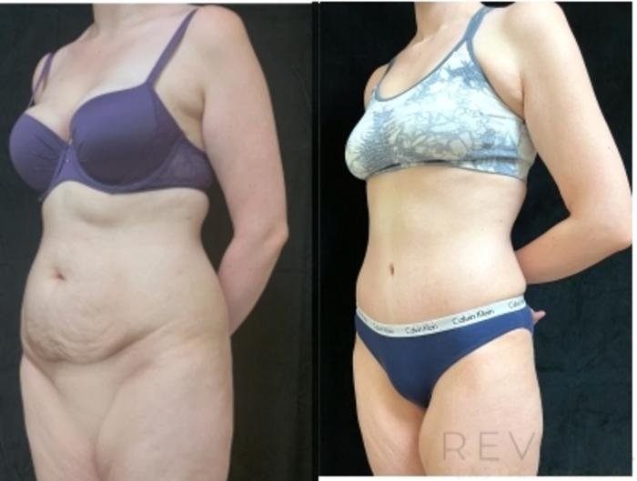 Before & After Mommy Makeover Case 605 Left Oblique View in San Jose, CA