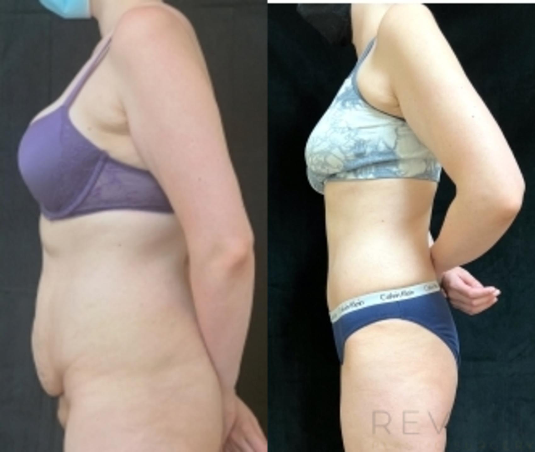 Before & After Tummy Tuck Case 605 Right Side View in San Jose, CA