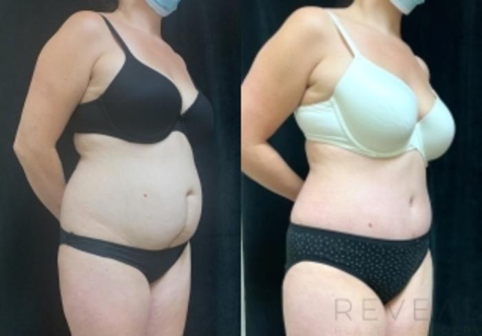 Before & After Tummy Tuck Case 606 Left Oblique View in San Jose, CA