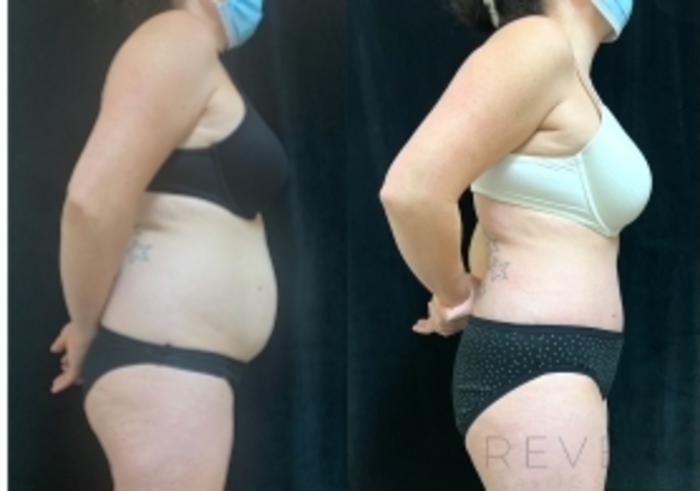 Before & After Tummy Tuck Case 606 Left Side View in San Jose, CA