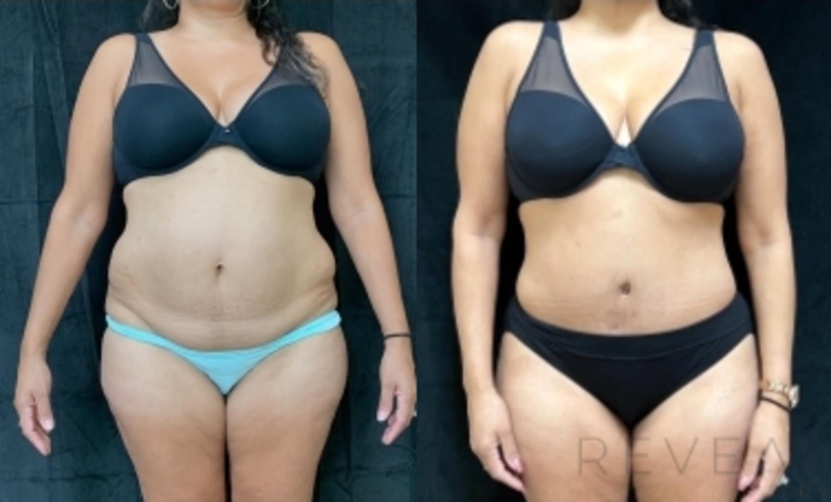 Before & After Tummy Tuck Case 607 Front View in San Jose, CA