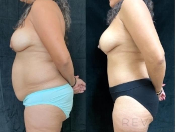 Before & After Tummy Tuck Case 607 Right Side View in San Jose, CA