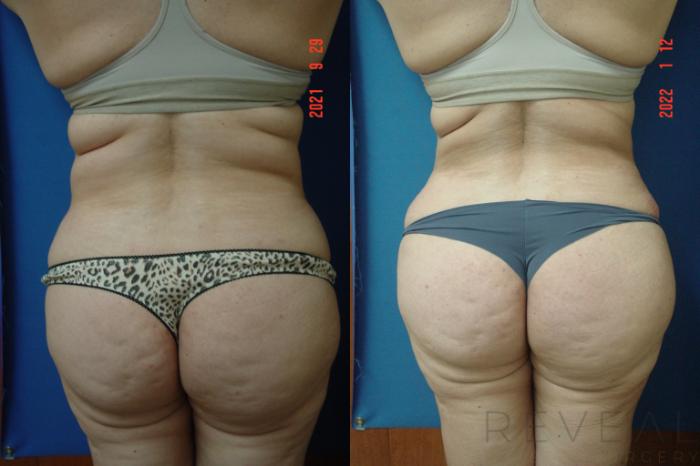 Before & After Liposuction Case 609 Back View in San Jose, CA