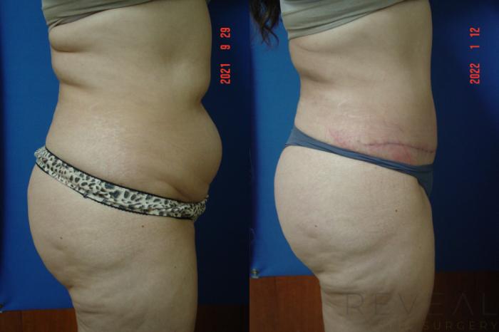 Before & After Liposuction Case 609 Left Oblique View in San Jose, CA