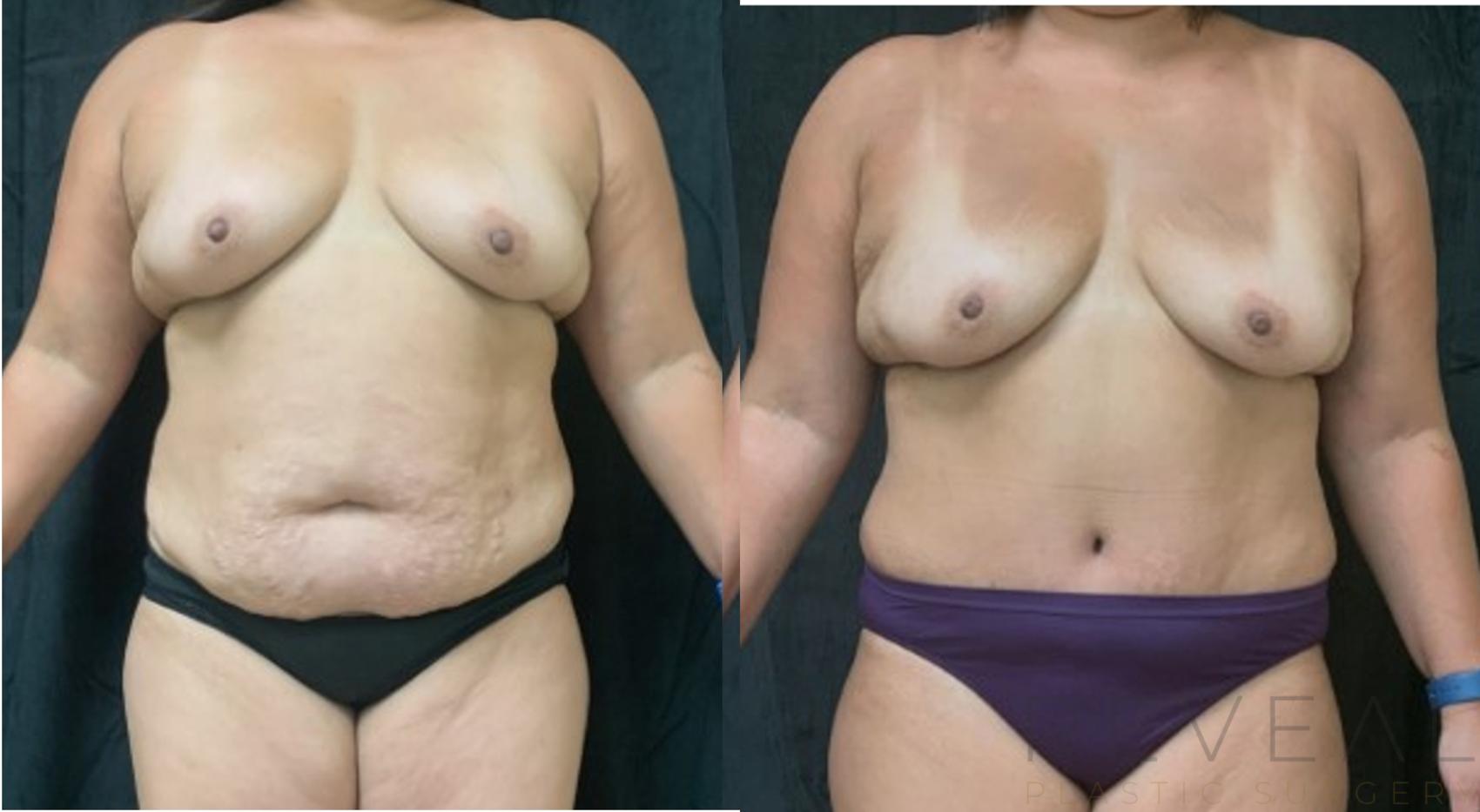 Before & After Tummy Tuck Case 616 Front View in San Jose, CA