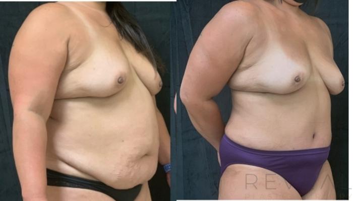 Before & After Tummy Tuck Case 616 Right Oblique View in San Jose, CA