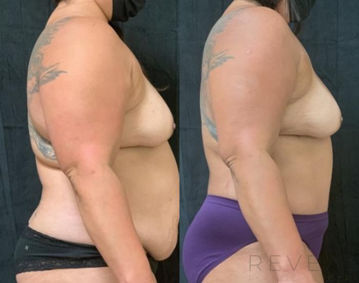 Before & After Liposuction Case 616 Right Side View in San Jose, CA