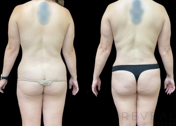 Before & After Tummy Tuck Case 620 Back View in San Jose, CA