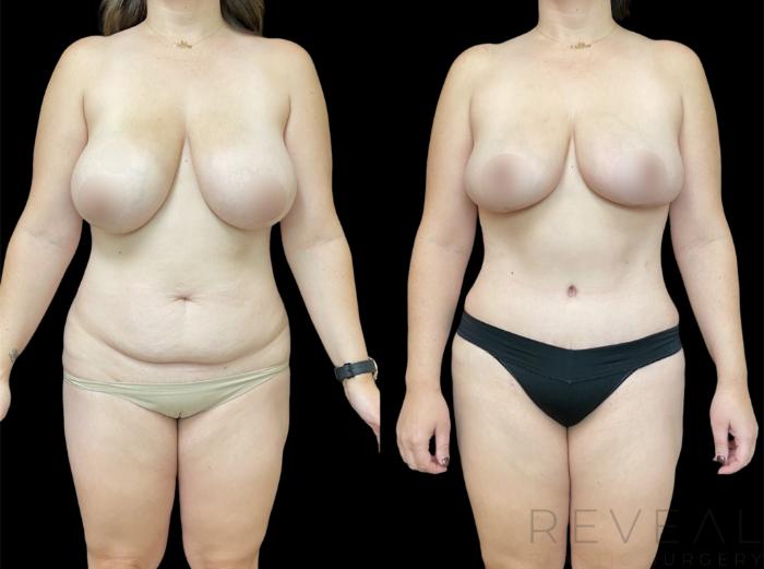 Before & After Liposuction Case 620 Front View in San Jose, CA