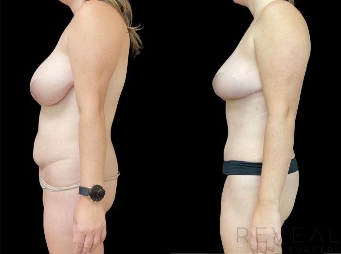 Before & After Tummy Tuck Case 620 Left Side View in San Jose, CA