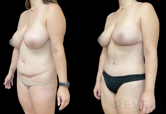 Before & After Tummy Tuck Case 620 Right Oblique View in San Jose, CA