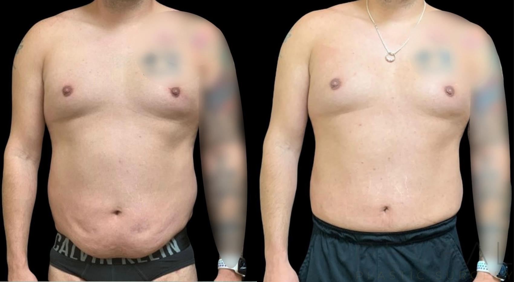 Before & After Tummy Tuck Case 626 Front View in San Jose, CA