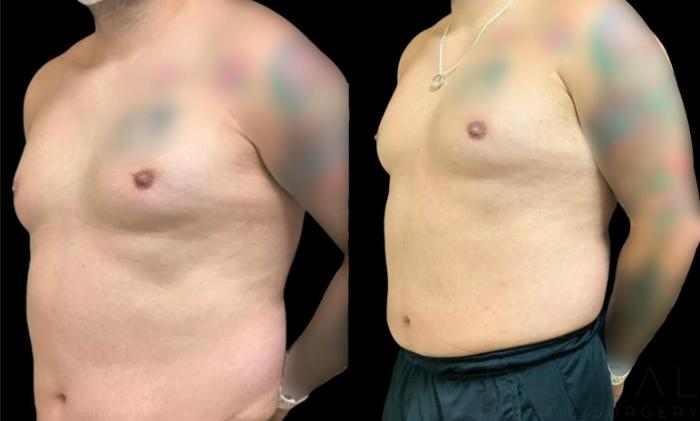 Before & After Liposuction Case 626 Left Oblique View in San Jose, CA