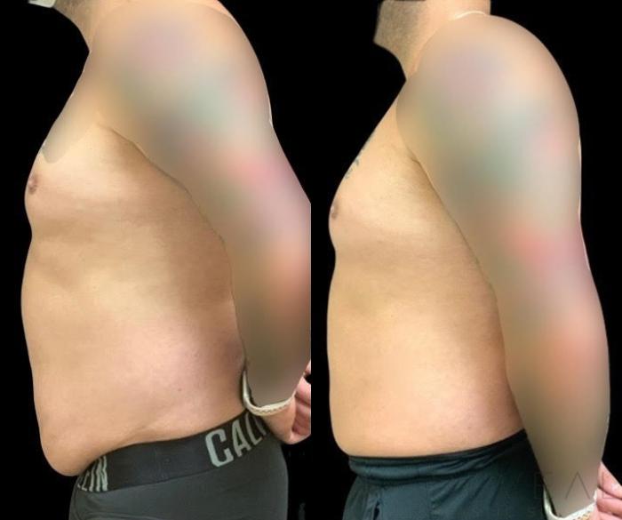Before & After Liposuction Case 626 Left Side View in San Jose, CA