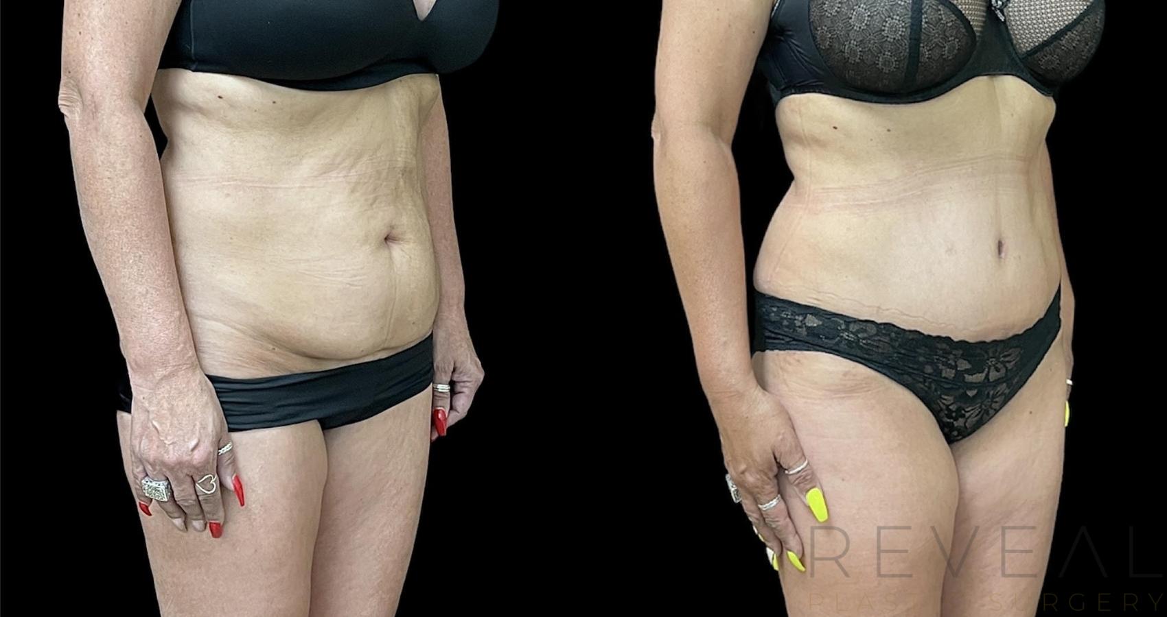 Before & After Tummy Tuck Case 638 Front View in San Jose, CA