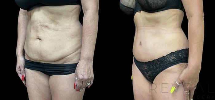 Before & After Tummy Tuck Case 638 Left Oblique View in San Jose, CA