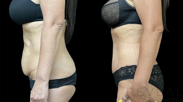 Before & After Tummy Tuck Case 638 Left Side View in San Jose, CA