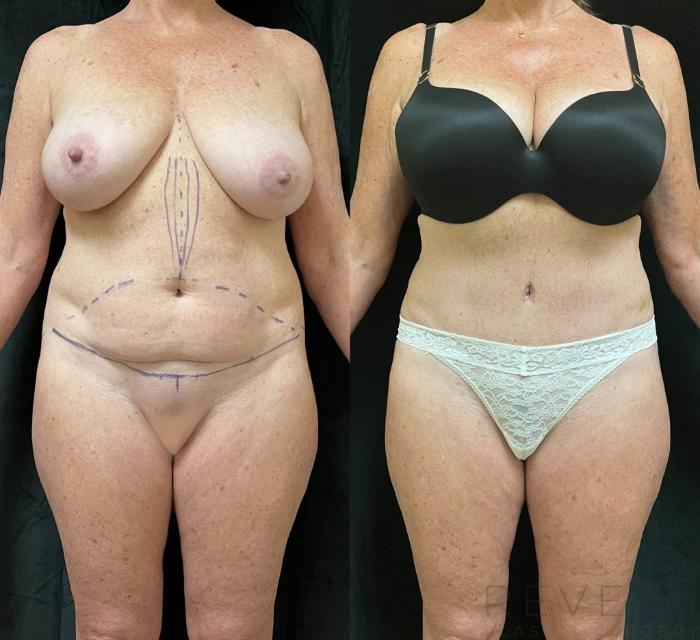 Before & After Tummy Tuck Case 641 Front View in San Jose, CA