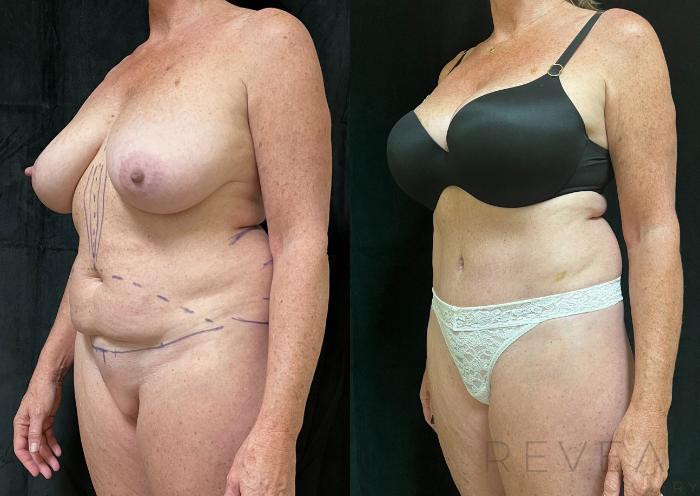 Before & After Tummy Tuck Case 641 Right Oblique View in San Jose, CA