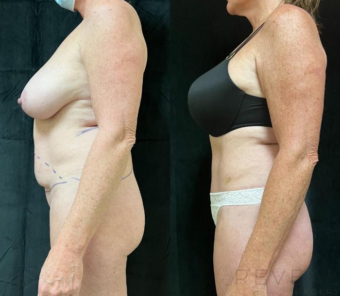 Before & After Tummy Tuck Case 641 Right Side View in San Jose, CA