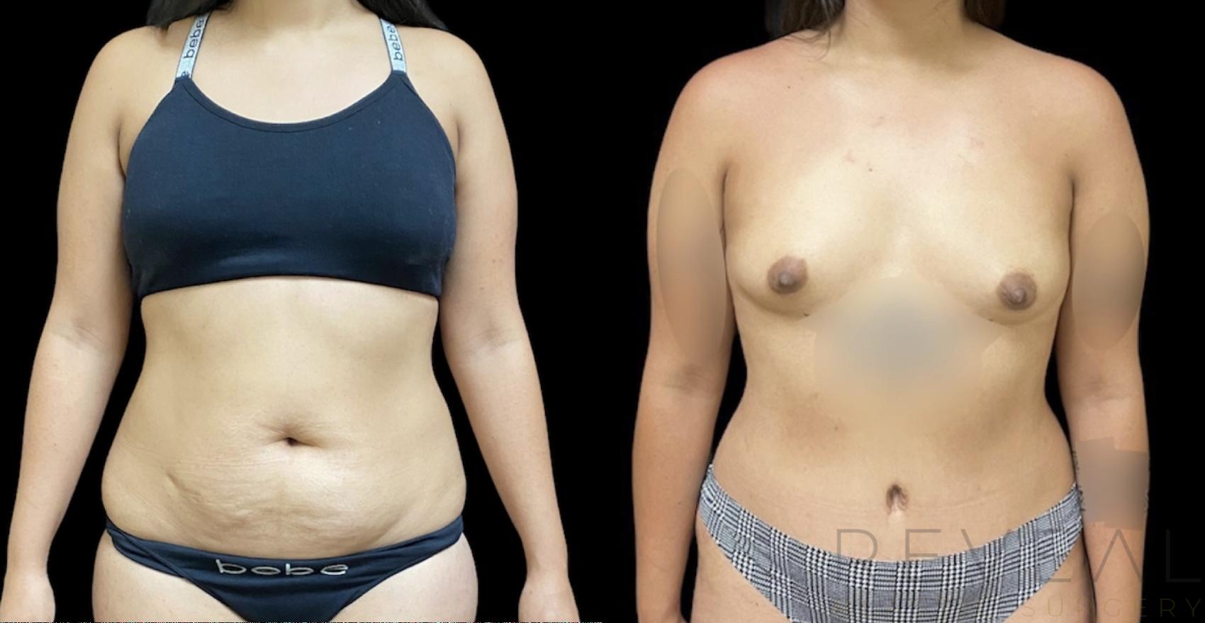 Before & After Liposuction Case 642 Front View in San Jose, CA