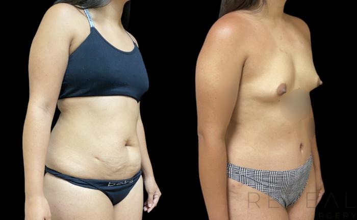 Before & After Tummy Tuck Case 642 Left Side View in San Jose, CA