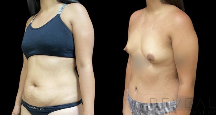 Before & After Tummy Tuck Case 642 Right Oblique View in San Jose, CA