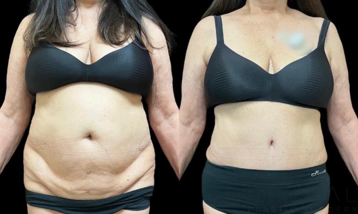 Before & After Tummy Tuck Case 656 Front View in San Jose, CA