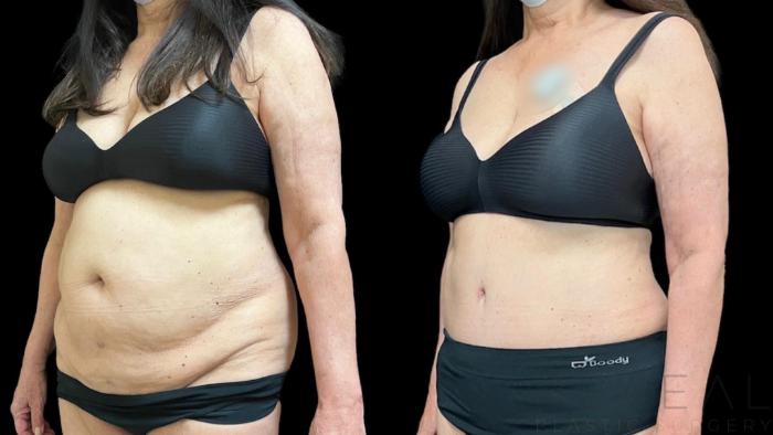 Before & After Tummy Tuck Case 656 Right Oblique View in San Jose, CA