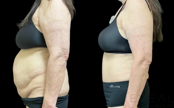 Before & After Tummy Tuck Case 656 Right Side View in San Jose, CA