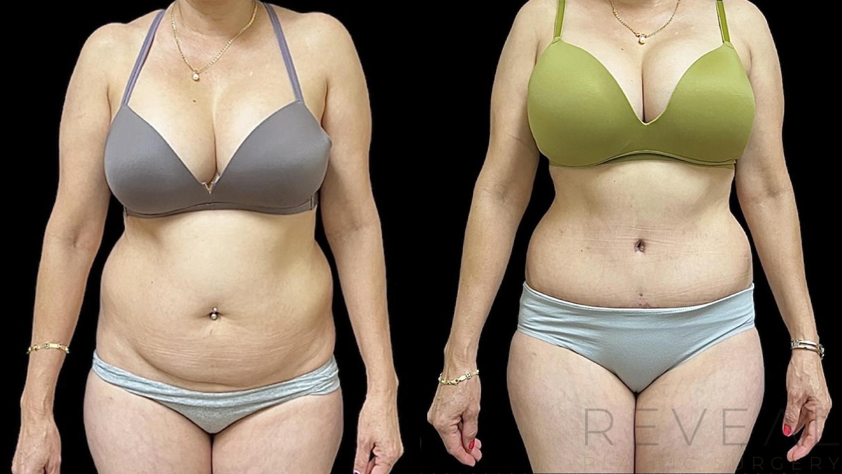 Before & After Tummy Tuck Case 659 Front View in San Jose, CA
