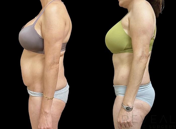 Before & After Tummy Tuck Case 659 Right Side View in San Jose, CA