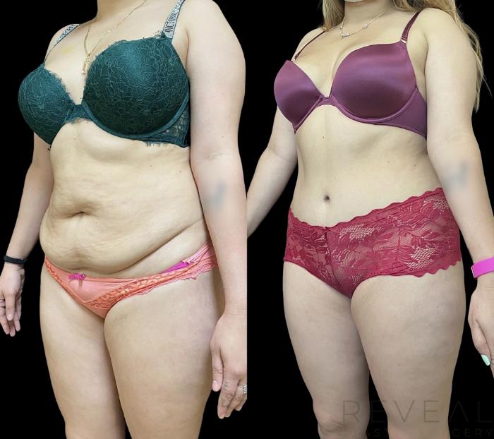 Before & After Tummy Tuck Case 667 Right Oblique View in San Jose, CA