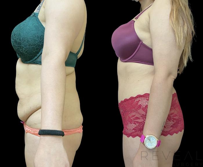 Before & After Tummy Tuck Case 667 Right Side View in San Jose, CA