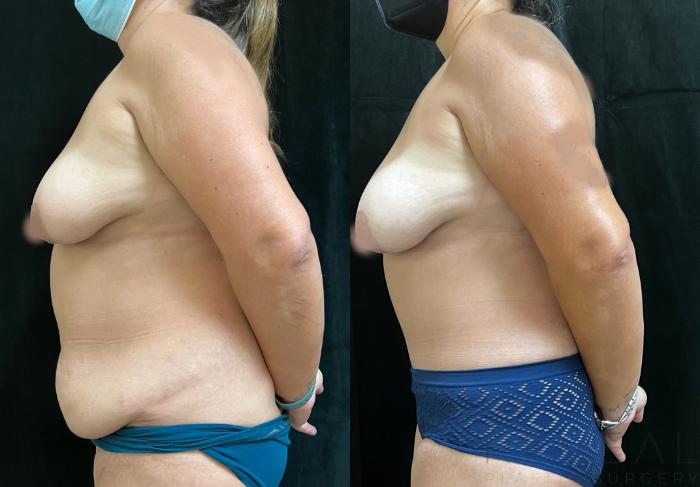 Before & After Tummy Tuck Case 673 Left Oblique View in San Jose, CA