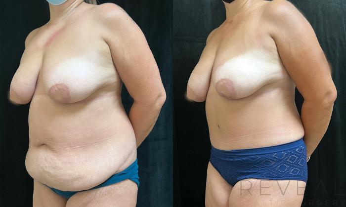 Before & After Tummy Tuck Case 673 Left Side View in San Jose, CA
