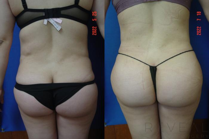 Before & After Brazilian Butt Lift Case 683 Back View in San Jose, CA