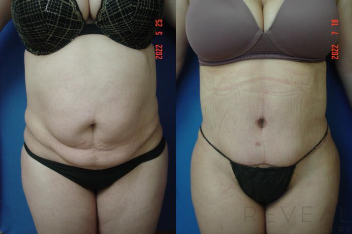 Before & After Brazilian Butt Lift Case 683 Front View in San Jose, CA