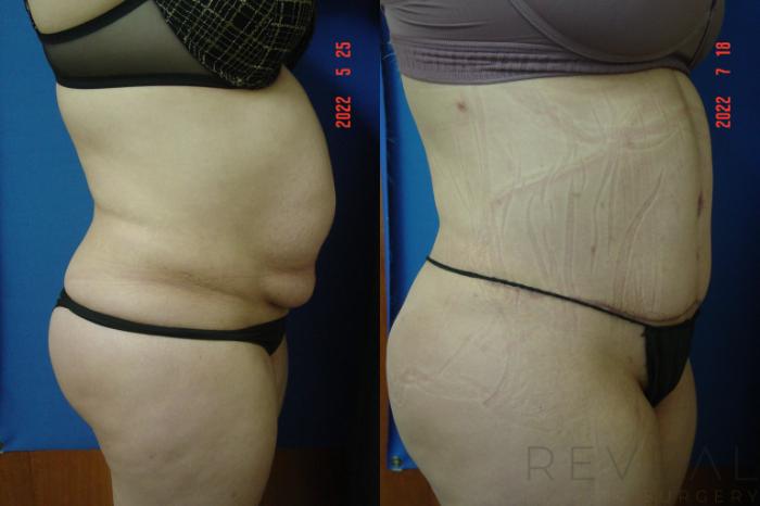 Before & After Tummy Tuck Case 683 Left Side View in San Jose, CA
